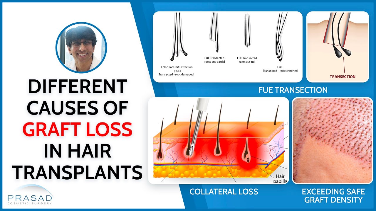 Hair Transplant - Causes of Graft Loss