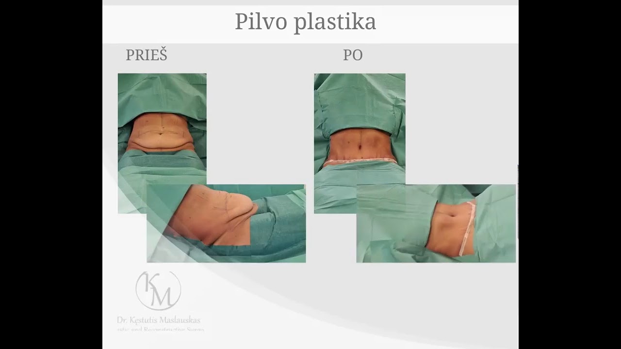 Pilvo plastika - rezultatai prieš ir po operacijos