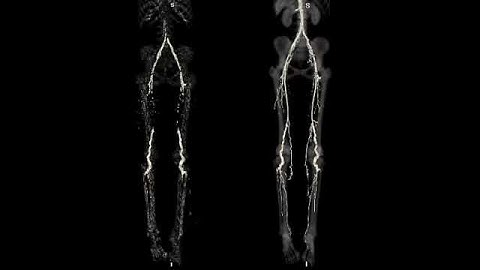 Vascular Calcification and Obstruction in a Study Patient