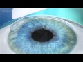 LASEK-PRK Procedure Animation