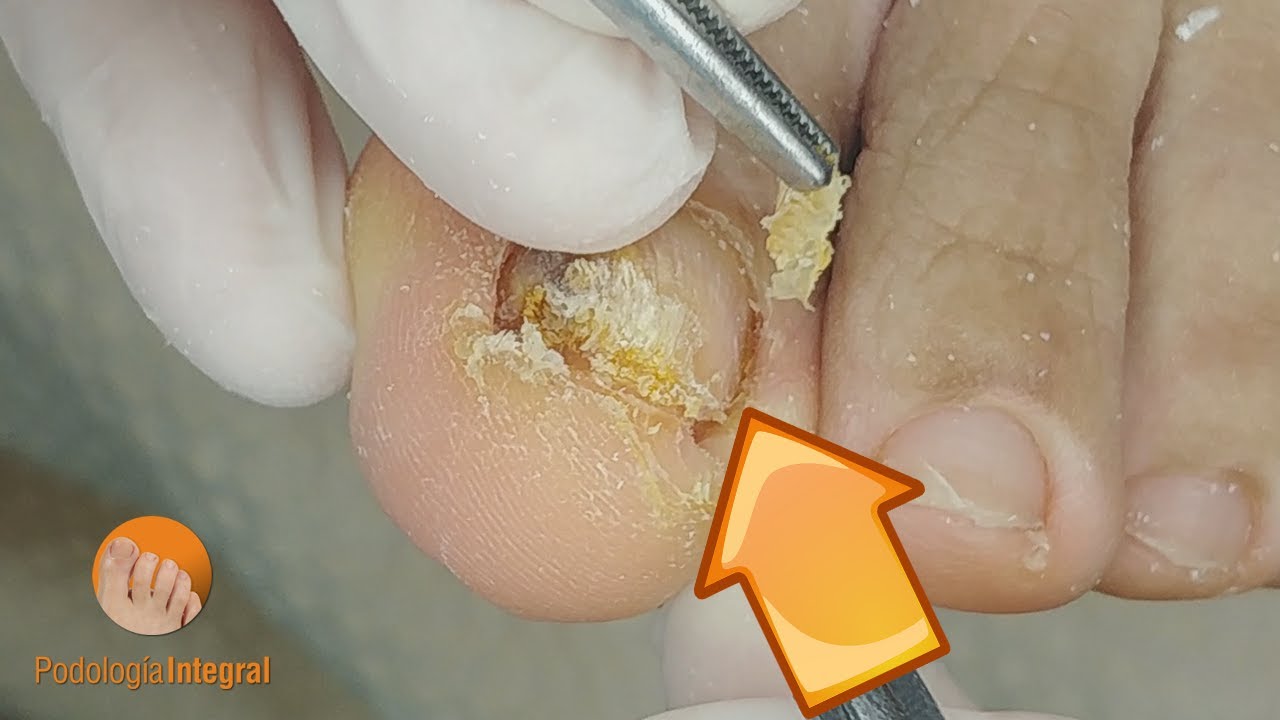 Difficult callus removal YouTube