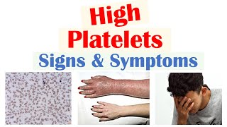 High Platelets (Thrombocytosis) Signs \& Symptoms | Rapid Review