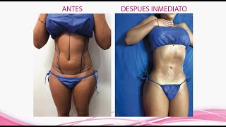 Cómo es una liposucción a laser (laserlipolisis) - ANTES &amp; DESPUÉS - Hefziba