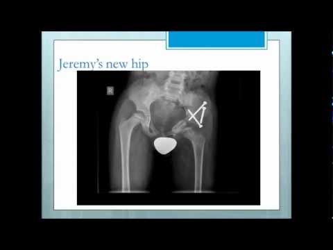 Legg-Calve-Perth...  disease power point