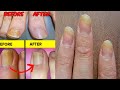in just 2 Days How To Get Rid of TOENAIL FUNGUS, How to Treat Fungal Toenails, Remedies for Toenai