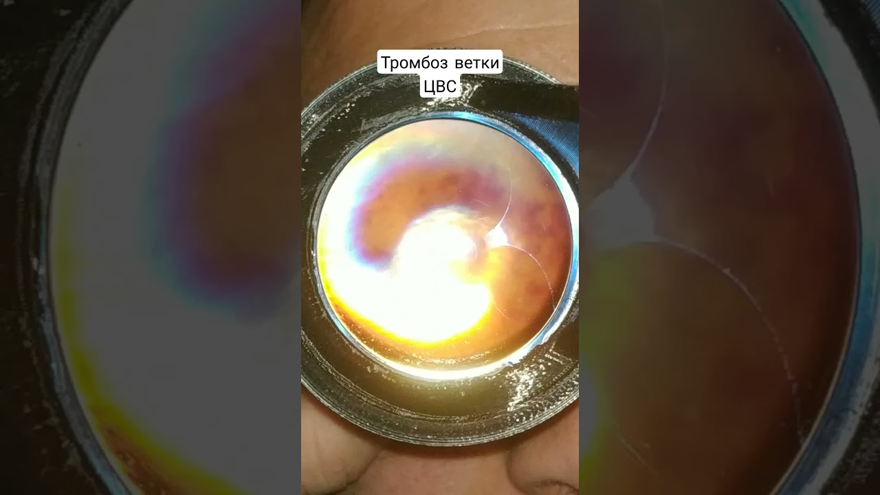 Тромбоз ветви ЦВС - YouTube