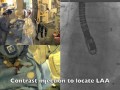 Closure of LAA with Cardia Ultraseal Device, Prof Goy August 2016