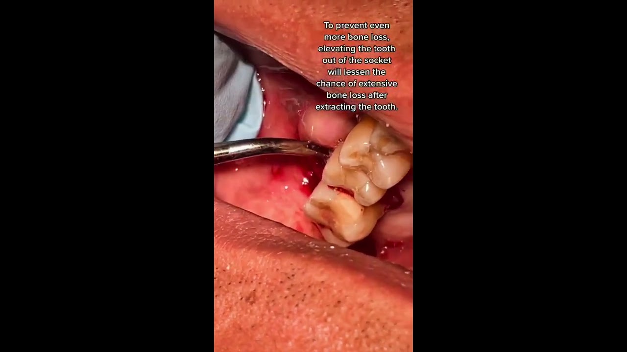 Broken Molar Tooth 3 Extraction Using Elevator In Office To Hands On Dental Training
