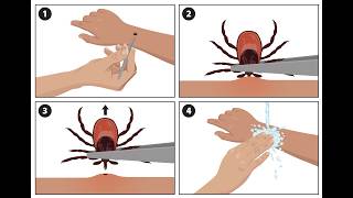 Emergency room visits for tick bites rise this year