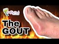 SQUEEZING OUT GOUT CRYSTALS FROM A FOOT