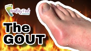SQUEEZING OUT GOUT CRYSTALS FROM A FOOT