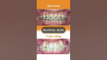 Hành trình LỘT XÁC nhờ niềng răng của Bích Trâm