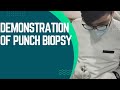 punch biopsy procedure||#pacific dental college||#punch  biopsy#//by sajad