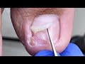 Manicure: Ingrown nails, causing inflammation【辥一刀】