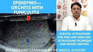 Epididymo orchitis ultrasound | epididymitis | Funiculitis ultrasound | scrotal ultrasound | testis