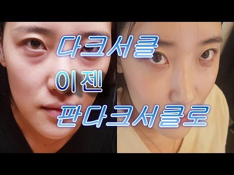 다크서클수술  2 주후까지  총정리