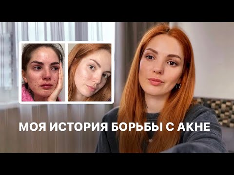 КАК Я ВЫЛЕЧИЛА ПРЫЩИ?! МОЯ ИСТОРИЯ С АКНЕ. МОЙ УХОД ЗА КОЖЕЙ