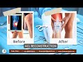 Patients after acl reconstruction surgery  dr amyn rajani  oaks clinic