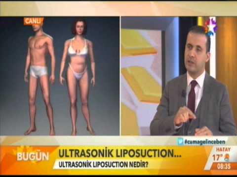 Op. Dr. Hüseyin Kandulu / Start TV Bugün - Ultrasonic Liposuction
