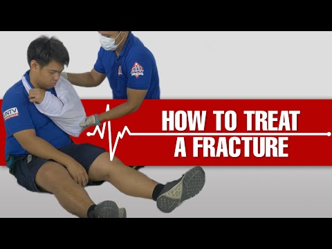 Video: Paano Magbigay ng First Aid para sa isang Broken Bone: 8 Hakbang