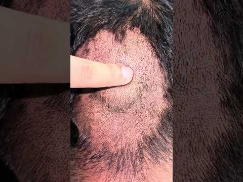 SCALP lipoma