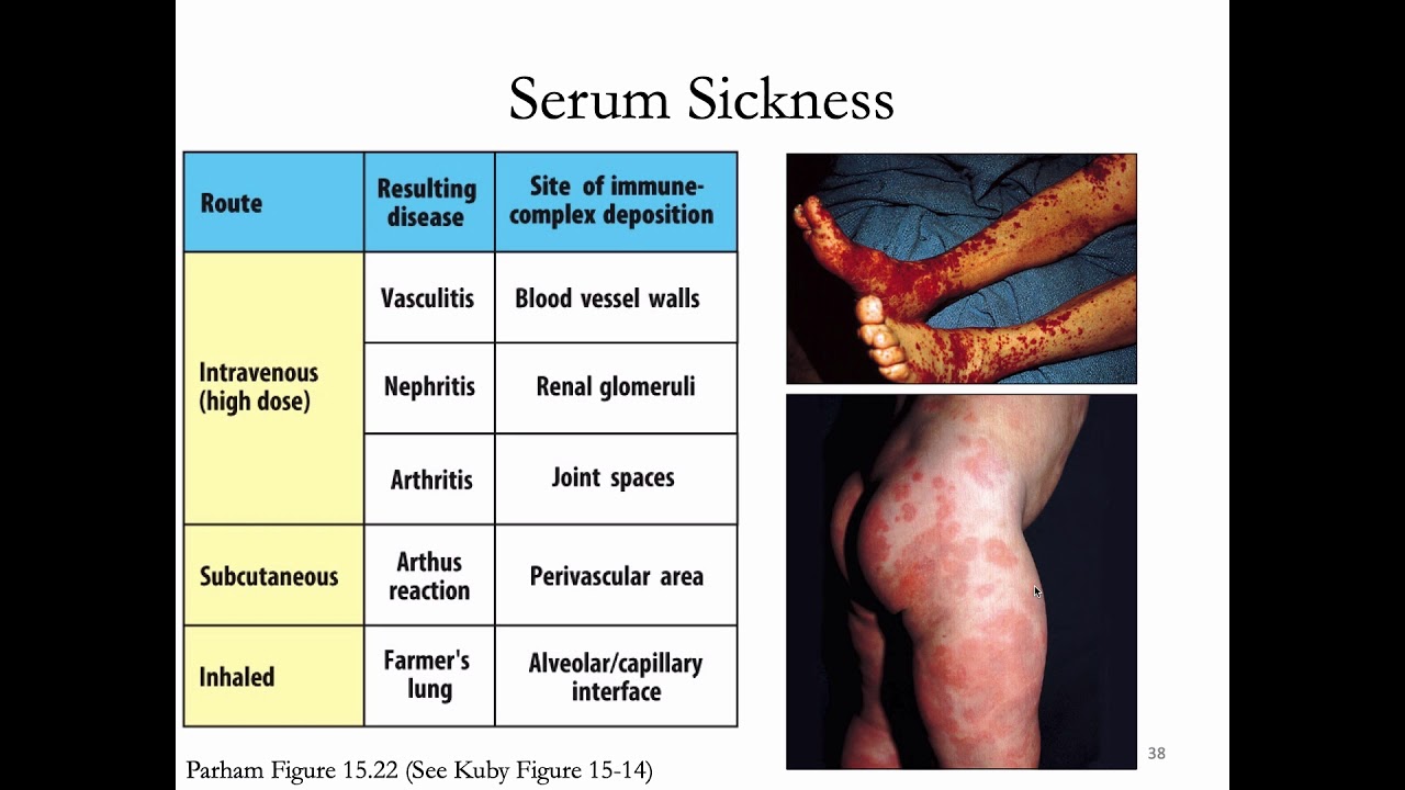 Immunology Lecture 31 Hypersensitivity (Allergy) 2 and Immunotherapies