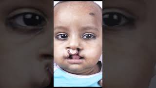 Cleft lip baby amazing transformation in only 5 Days