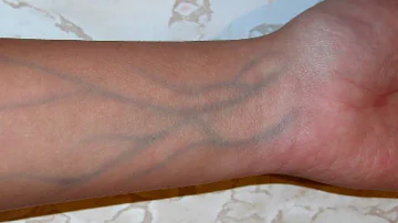 5 Signs Of  Poor Blood Circulation That You Shouldn't Ignore