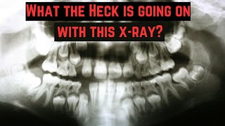 Adult teeth and baby teeth on a dental x-ray