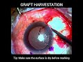 Pterygium surgery