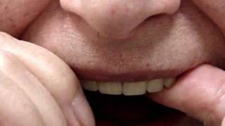 Inserting and removing implant denture