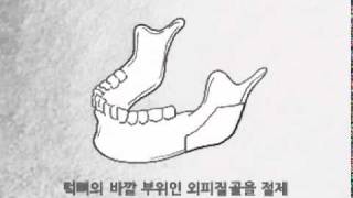 1 피질골절제술