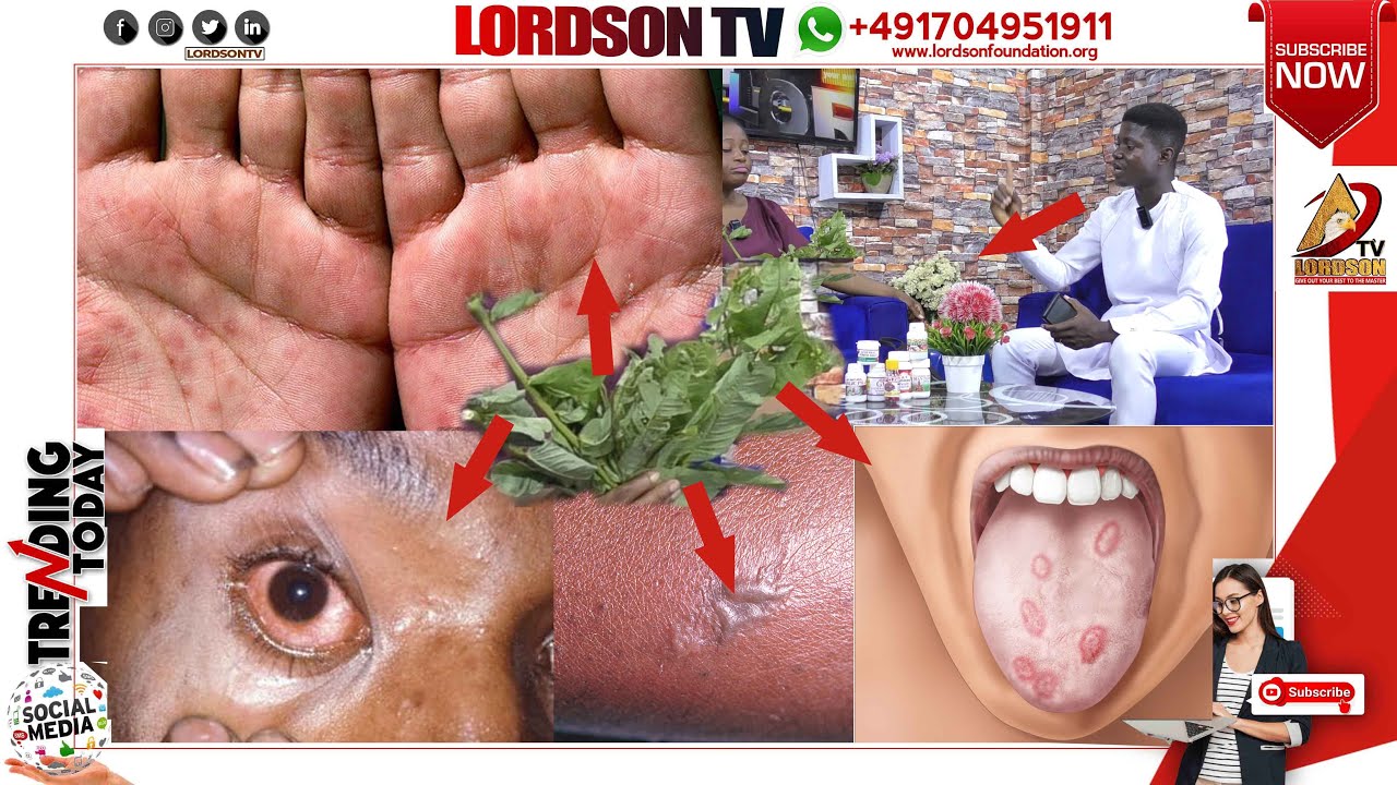 USE THIS HERBS TO CURE YOUR GONORRHEA. A SECRET NOBODY WILL TELL YOU