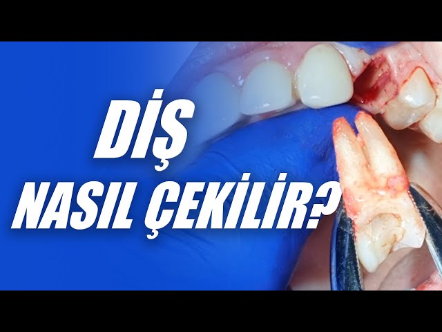 Diş Nasıl Çekilir? Diş Çekilirken Nelere Dikkat Edilmelidir? Diş Çekimi Nasıl Yapılır? class=