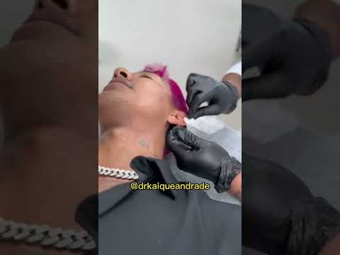 O dia que fiz minha harmonização de orelhas.??? #entreterimento #estetica