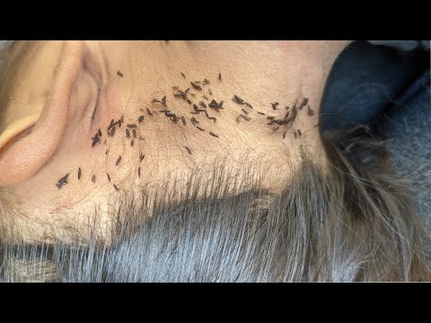 Remove all thousand lice from her hair - Pick out all of big lice from her head