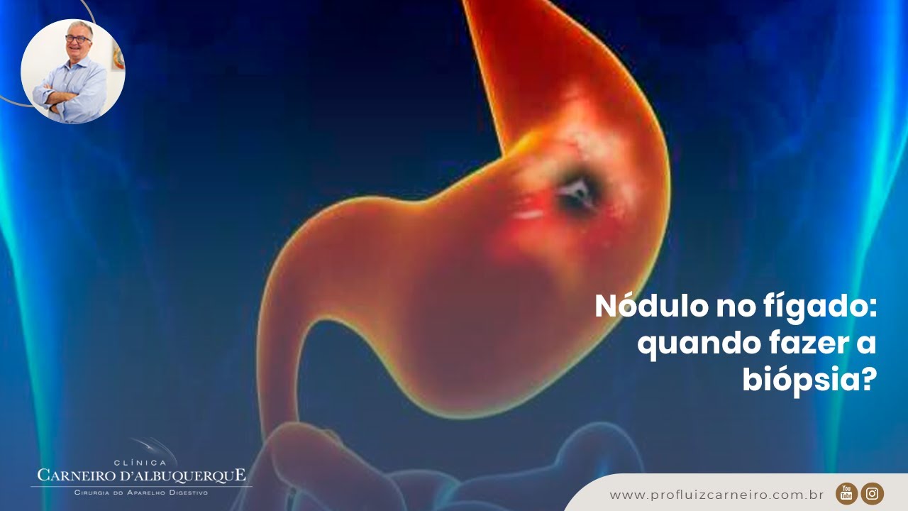 Nódulo no fígado quando fazer a biópsia? Prof. Dr. Luiz Carneiro CRM 22761 YouTube Nódulo no fígado quando fazer a biópsia? Prof. Dr. Luiz Carneiro CRM 22761 YouTube