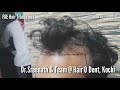 Hair transplant  what happens after 10 days  results after fue  drsreenath