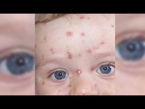 Cuidados de la varicela. Chicken Pox treatment. ecodaisy 