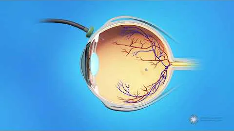 Vitrectomy Surgery for Macular Holes