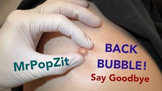 Bubble bump on back removal. Very shallow sac pushing through to the surface. Would have popped