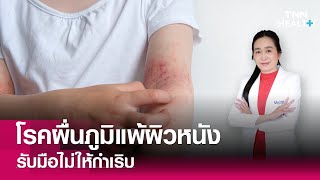 โรคผื่นภูมิแพ้ผิวหนัง รับมือ ไม่ให้กำเริบ : TNN Health