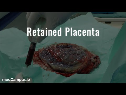 Video: Ano ang retained placenta?