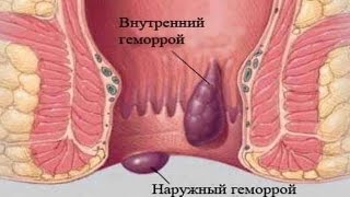 видео Как и чем лечить и вылечить анальную трещину и можно ли это сделать в домашних условиях?