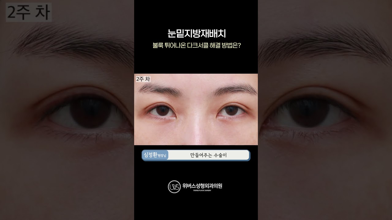 [Виверс гоо сайхны мэс заслын эмнэлэг] Нүдний доорх хар хүрээ 🙄 Нүдний доорх өөхөн давхаргыг дахин байршуулах