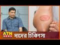 à à à à à à à à à à à à à Skin Desists Ringworm Health Tips ATN News à à à à à à à à à à à à à Skin Desists Ringworm Health Tips ATN News