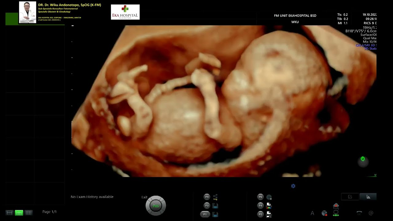 TRISOMY 21 - Down Syndrome - Hydrops Fetalis (Dr Wiku Andonotopo)