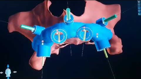 Bone Supported Surgical Guide