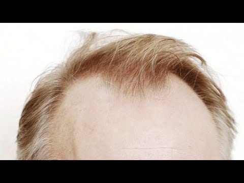 top-10-hairstyles-for-balding-men-ideas