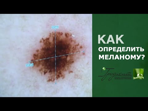 МЕЛАНОМА - КАК РАСПОЗНАТЬ и не допустить развития рака кожи. Дерматоскопия и Фотодерматоскопия.